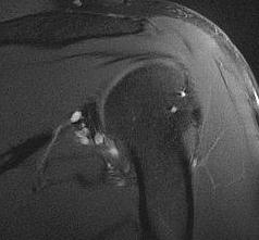 Shoulder Posterior Labral Tear with Cysts0002